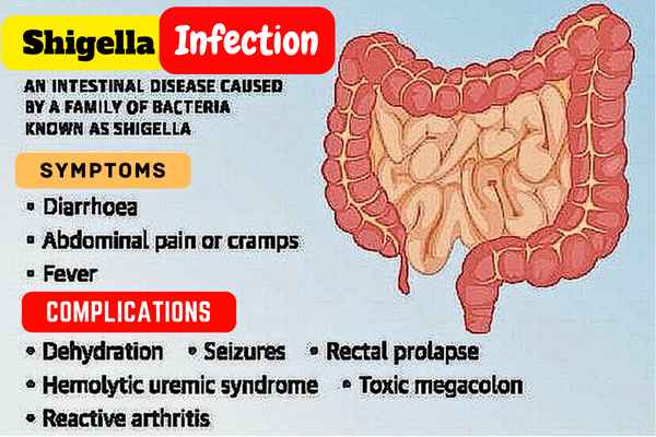 Shigella Infected Digestive System and Symptom List.