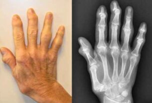 Hand affected by Hand Osteoarthritis - Illustration