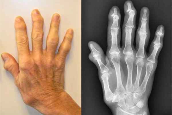 Hand affected by Hand Osteoarthritis - Illustration