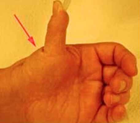 Thumb deformity caused by Hand Osteoarthritis - Illustration
